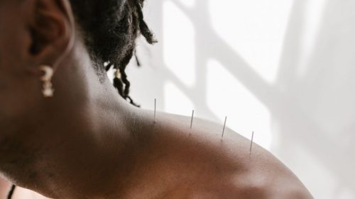 Detailed view of acupuncture needles applied to a shoulder for therapeutic treatment.