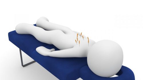 Supporting image for acupuncture for lower back pain