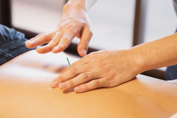 Crop anonymous male doctor putting needles on back during acupuncture therapy session in rehabilitation salon