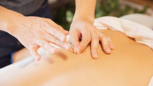 From above of crop anonymous man applying needles on back of client during acupuncture procedure